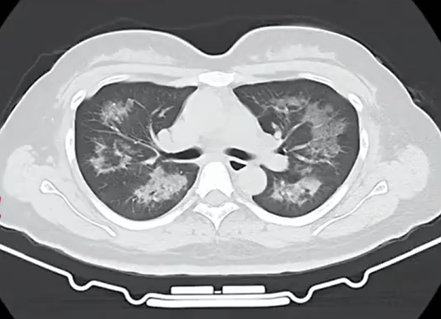 每天用2次，22岁女主播肺里长满阴影！很多人不注意